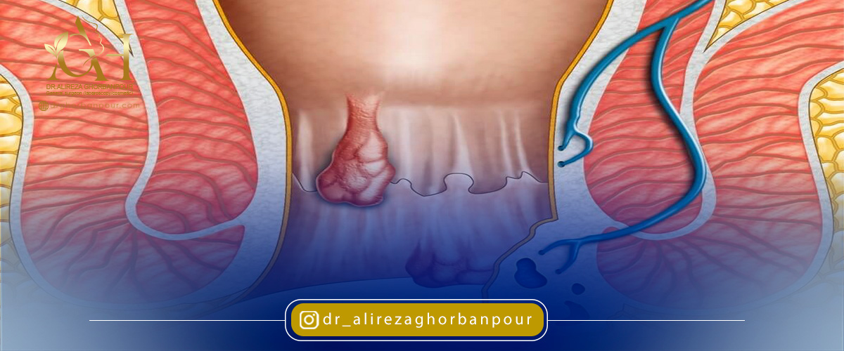بواسیر چگونه ایجاد میشود؟