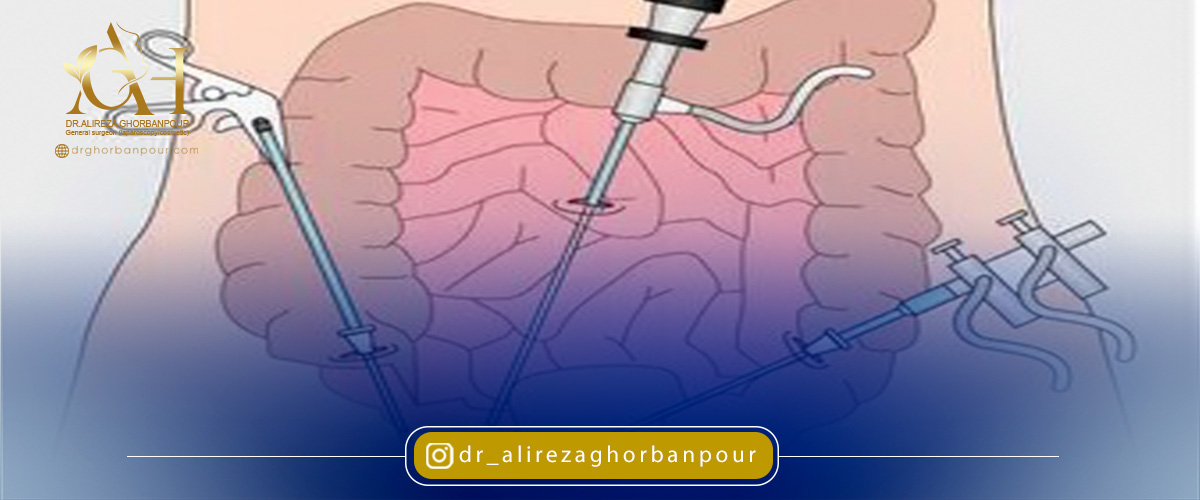 تفاوت لاپاراتومی با لاپاراسکوپی