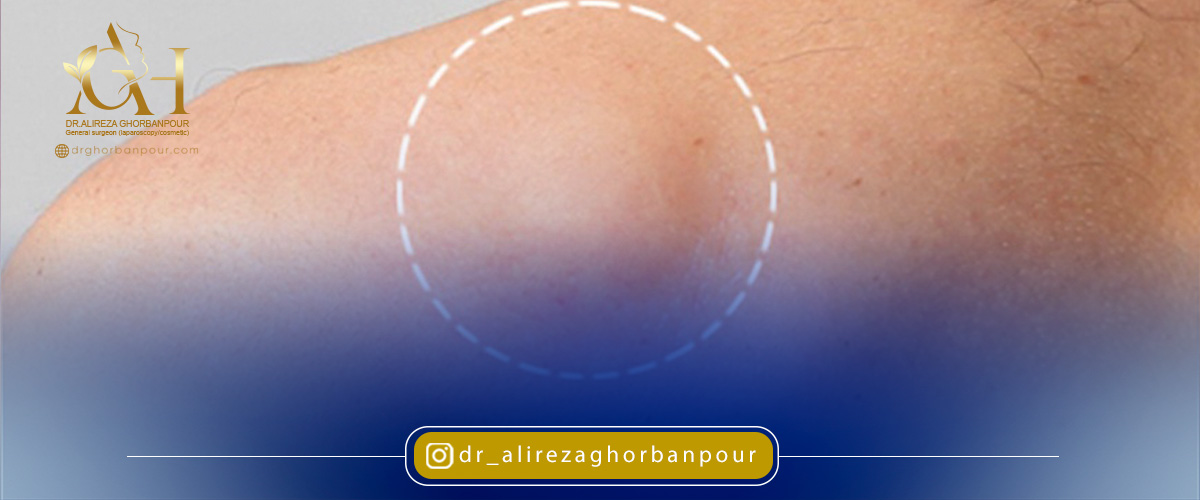 علت ایجاد و عوامل تاثیرگذار در ایجاد توده های چربی چیست؟