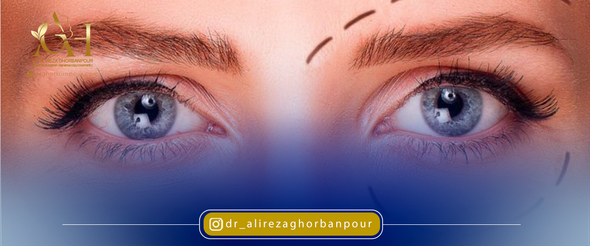 چه زمانی بلفاروپلاستی ضروری است؟