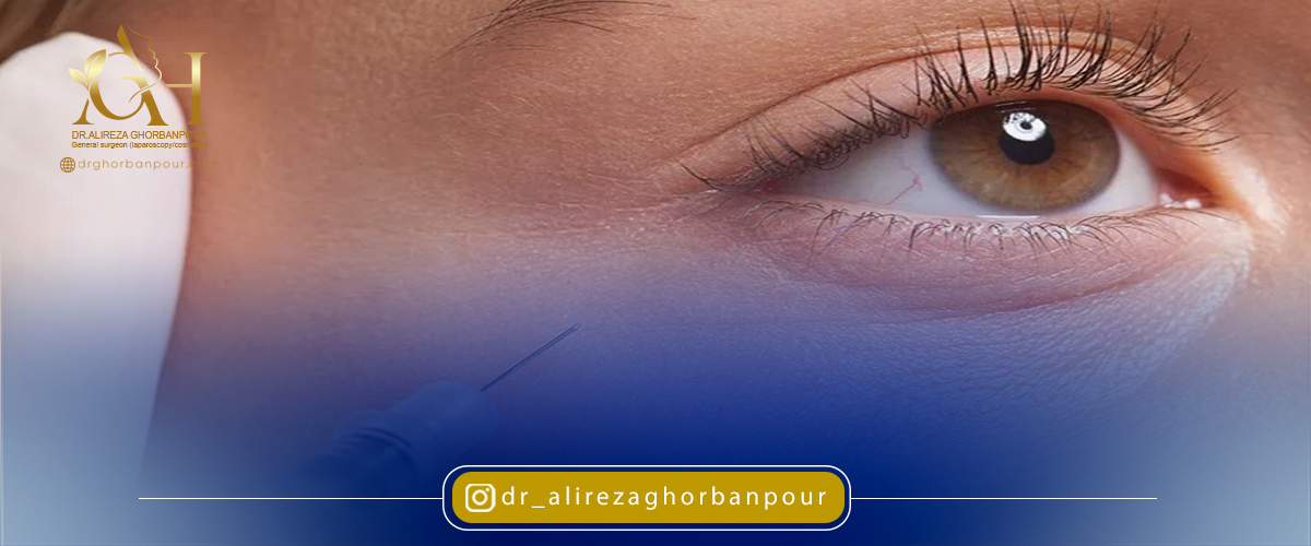 ماندگاری فیلر چشم چقدر است؟