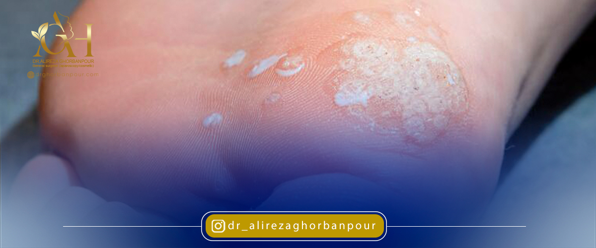زگیل های موزاییکی