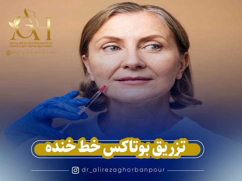 تزریق بوتاکس خط خنده